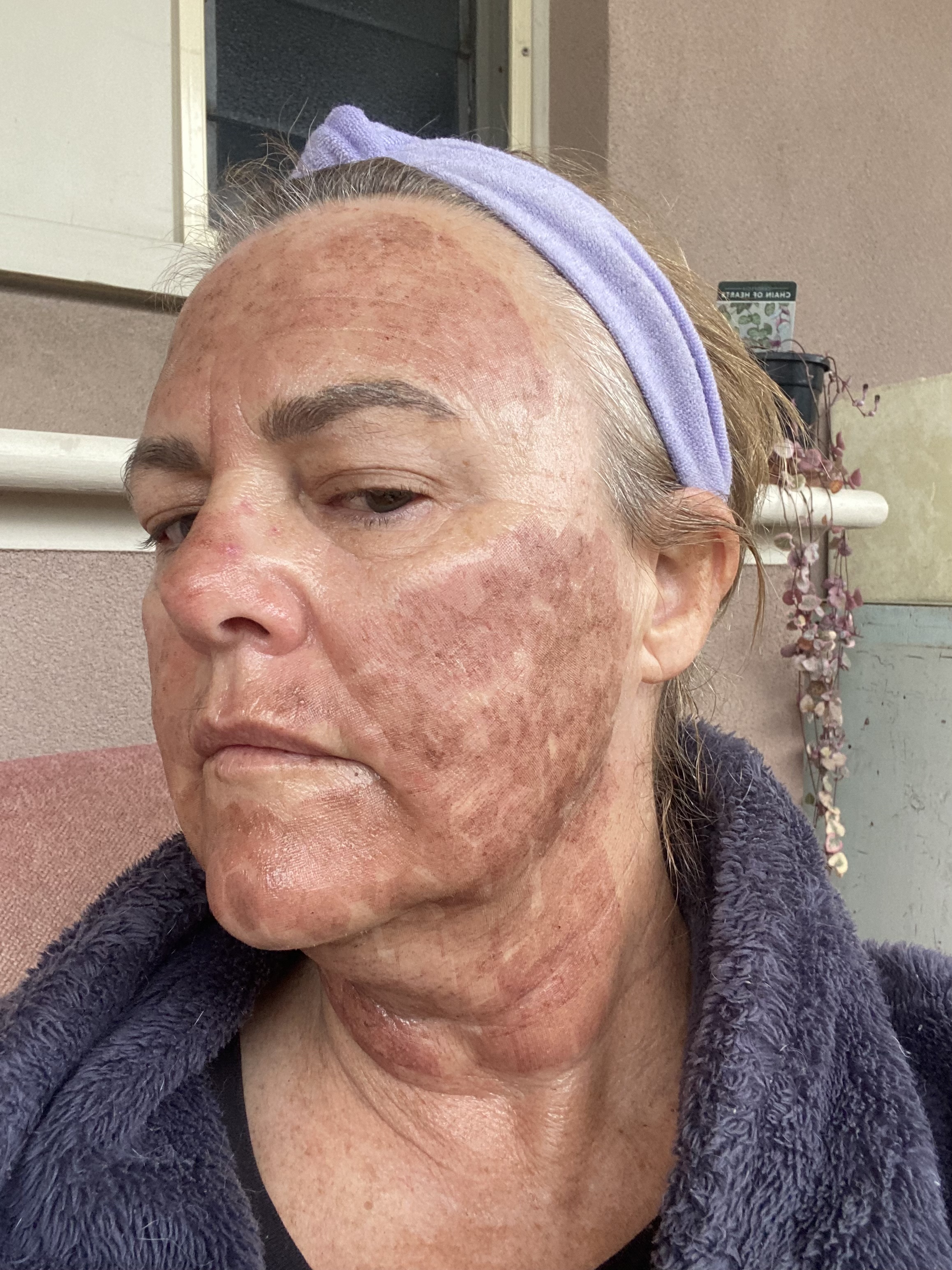 CO2 Laser Resurfacing Healing Phase